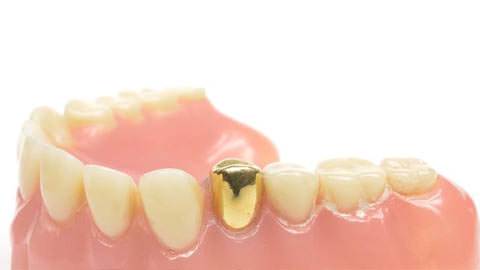 Zahngold / Dentalgold-Ankauf